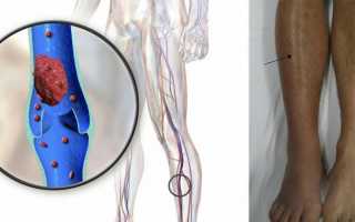 Симптомы и лечение тромбоза (тромбофлебита) глубоких вен нижних конечностей