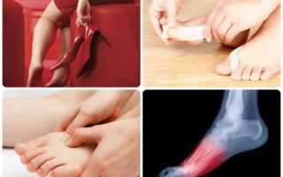 Болят косточки на ноге около большого пальца – что делать?