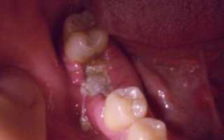 Белый налет в лунке после удаления зуба: фото, причины и лечение