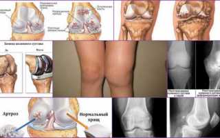 Что такое деформирующий артроз коленного сустава и как его лечить?