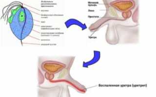 Что такое бактериальный уретрит у женщин и уретропростатит у мужчин
