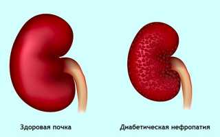 Симптомы диабетической нефропатии: диагностика и лечение