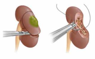 Показания к проведению резекция почки: виды и осложнения
