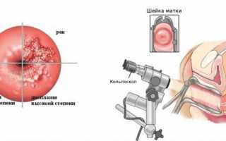 Что может происходить после кольпоскопии и как себя вести