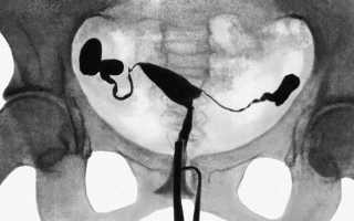 Метросальпингография при планировании беременности