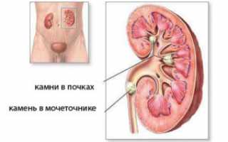 Анурия – понятие, как распознать, методы лечения