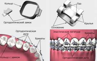 Керамические брекеты: фото до и после установки керамической брекет-системы, преимущества и недостатки, стоимость