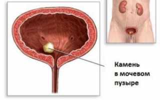 Заболевания мочевого пузыря: виды, клинические проявления, лечение