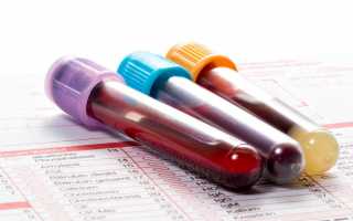 Зачем и когда сдавать анализ крови на TORCH-инфекции при беременности
