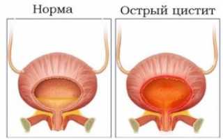 Лечение цистита народными средствами с помощью пшена