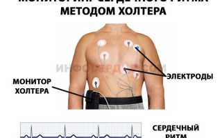 Как вовремя распознать микроинфаркт и что дальше делать?