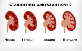 Причины увеличенной лоханки у плода: симптомы и прогноз