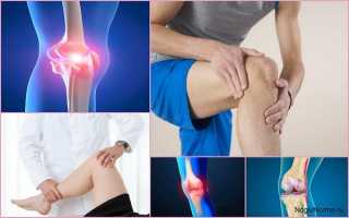 Пателлофеморальный артроз коленного сустава — что это такое, чем и как лечить патологию?