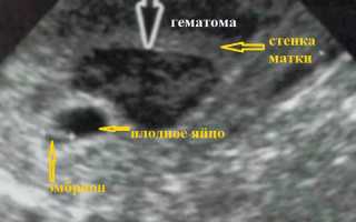 Почему после УЗИ при беременности болит живот и появились выделения, опасно ли это