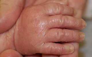 Ихтиоз кожи у детей — фото с описанием, лечение, причины и симптомы
