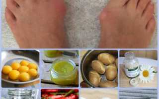 Как лечить народными средствами шишки на ноге возле большого пальца