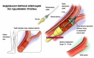 Артериальный тромбоз нижних конечностей