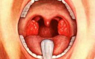 Гной на миндалинах: как возникает, причины и заболевания, проявления, лечение и профилактика