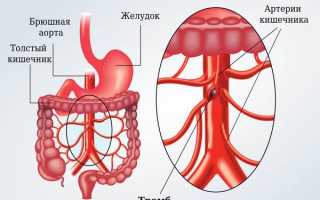 Чем опасен тромбоз мезентериальных сосудов?