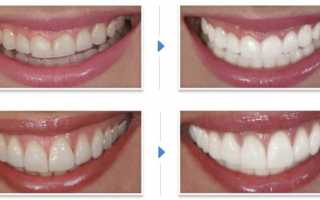 Как сделать зубы белыми в домашних условиях и в клинике, как сохранить белизну зубов