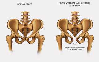 Симфизит при беременности: причины, ощущения, методы лечения