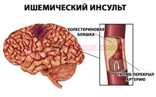 Что может провоцировать сужение сосудов головного мозга?