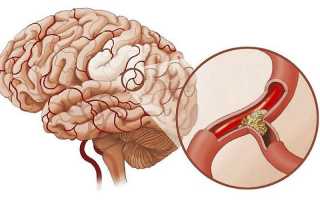 Что такое атеросклероз сосудов головного мозга и к чему он приводит?