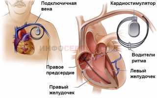 Симптомы и лечение брадиаритмии