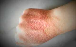 Холодовой дерматит — лечение, причины, симптомы