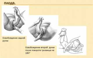 Роды при тазовом предлежании плода