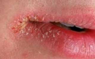 Трещины в уголках губ: причины возникновения, медикаментозные и народные средства лечения