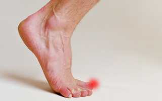 Почему немеет большой палец на ноге — что делать, как лечить онемение?