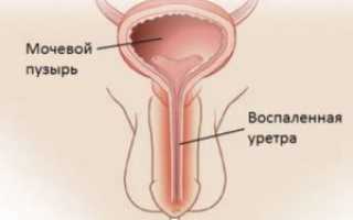 Народные методы лечения уретрита у мужчин и женщин в домашних условиях