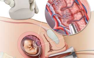 Амниоцентез при беременности, что это