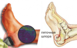 Лечение пяточной шпоры ультразвуком