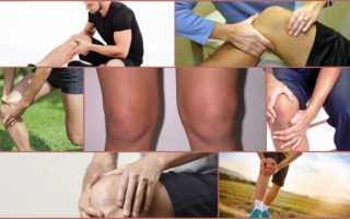 Лигаментит коленного сустава — что это такое и как его лечить?
