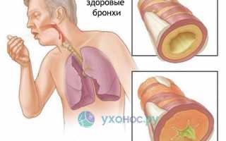 Кашель: как развивается, причины, разновидности и проявления, как лечить