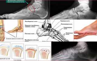 Симптоматика и лечение артроза таранно ладьевидного сустава