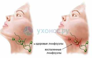 Стрептококковая инфекция: причины, признаки, диагностика, как лечить