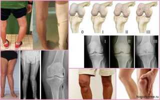 Гонартроз 3 степени коленного сустава — что это такое и как его лечить?