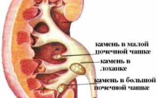 Микронефролитиаз — начальная стадия мочекаменной болезни