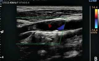 Что показывает УЗИ сосудов и вен и как его делают: подготовка, алгоритм и правильная расшифровка