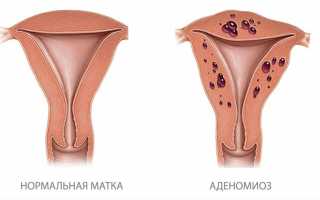 Аденомиоз и беременность: что это за заболевание, как проявляется, как влияет на плод
