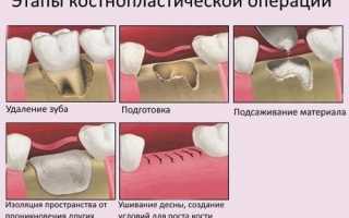 Сколько стоит вставить один имплантат зуба