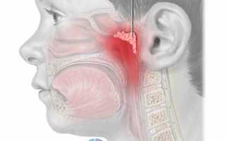 Аденоиды: причины, признаки, как лечить, показания к операции