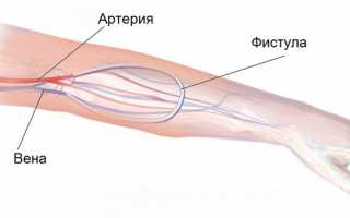 Применение фистулы для гемодиализа: уход и полезные советы