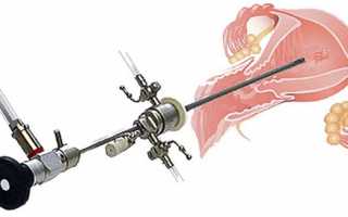 Почему после гистероскопии может болеть живот — причины дискомфорта и методы ее устранения