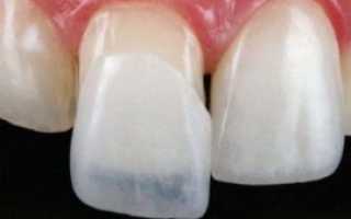 Виды вставных зубов, какие зубы лучше вставлять