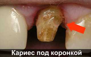 Почему болит зуб под коронкой и что с этим делать