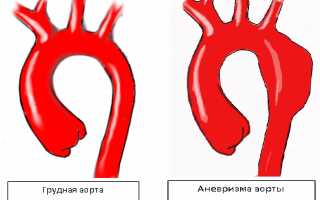 Симптомы и лечение аневризмы брюшного отдела аорты